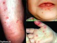 Bệnh tay chân miệng là gì? 