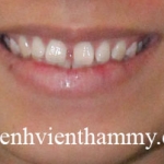 Chỉnh hình răng thẩm mỹ điều trị răng thưa