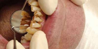 Thuốc lá gây ra bệnh gì?