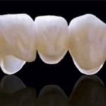 Có cần phải lấy tuỷ khi bọc răng sứ không?