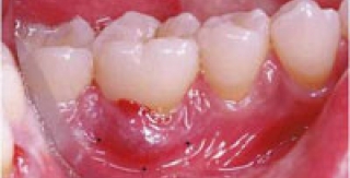 CÁCH ĐIỀU TRỊ BỆNH NHA CHU