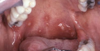 Biểu hiện vùng miệng của nhiễm HIV – AIDS