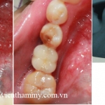 Cấy ghép răng implant 5