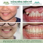 Niềng răng móm (khớp cắn ngược) ở trẻ em và người lớn