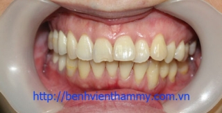 Trám răng Composite-Tetric-N-Ceram A3-DentinA3,5
