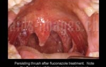 Một số biểu hiện nhiễm HIV ở họng 