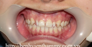 Trám răng Composite-Tetric-N-Ceram 1