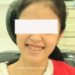 Cười hở nướu do răng ngắn