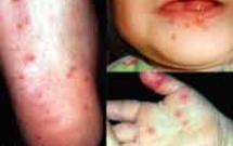 Kết quả của một số nghiên cứu về bệnh tay chân miệng 
