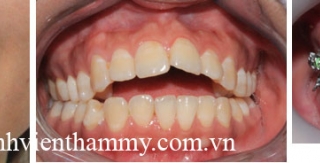 Chỉnh hình răng thẩm mỹ điều trị răng hô – cắn hở với mắc cài kim loại 2