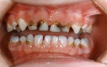 CHẾ ĐỘ ĂN VÀ SÂU RĂNG