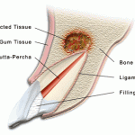 Tại sao khi lấy tủy xong ta phải bít ống tủy lại (Root canal obturation)? 