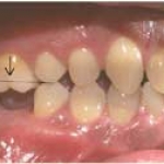 Chuyện gì xảy ra sau khi nhổ răng?