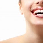 Niềng răng móm kèm răng chen chúc