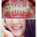 Niềng răng móm – Giải pháp hiệu quả cho khớp cắn lệch