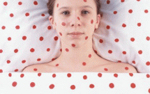 Bệnh Rubella