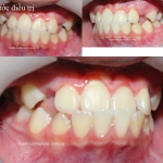 Chỉnh hình răng mặt can thiệp sớm - răng móm