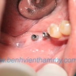 Phục hình implant 2 implant