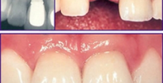 Có cách nào thay thế răng mất mà không cần làm cầu Răng?