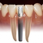 Tại sao cấy ghép răng(implant) là phương pháp ưu tiên? 