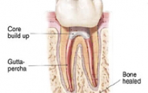 Răng chữa nội nha là răng chết như vậy có bền vững và giữ được lâu không? 