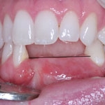 Mất răng nếu không được phục hồi ( làm răng giả ) sẽ đưa đến hậu quả gì ?