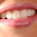 ĐIỀU TRỊ CƯỜI HỞ NƯỚU KẾT HỢP RĂNG SỨ THẨM MỸ