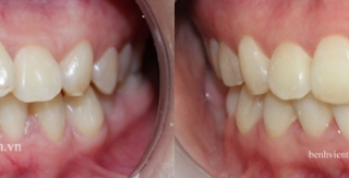 Chỉnh hình răng thẩm mỹ điều trị răng chen chúc với mắc cài kim loại 02