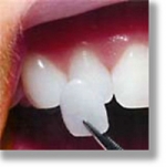 Một số phương pháp làm răng thẩm mỹ 