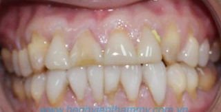 Răng sứ Emax Zircad - Ivoclar Vivadent 7