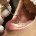 Phương pháp mới điều trị tụt Lợi/Nướu 