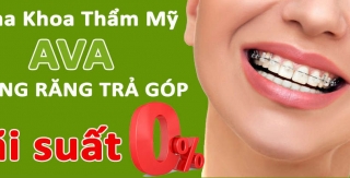 Niềng răng trả góp lãi suất 0%