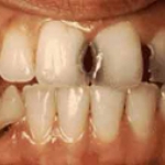 Răng sâu được chữa trị như thế nào? 