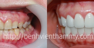 Răng sứ thẩm mỹ cải thiện nụ cười với răng nhiễm tertracyclin