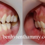 Răng sứ Emax Zircad - Ivoclar Vivadent - Thụy Sỹ 26
