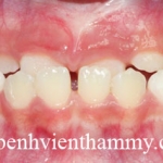 Chỉnh hình răng can thiệp sớm cắn ngược răng trước