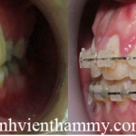 Chỉnh hình răng thẩm mỹ điều trị răng hô với mắc cài sứ