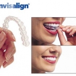 Invisalign - Kỹ thuật chỉnh nha thế hệ mới không mắc cài