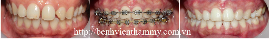nieng-rang-thamm-my010