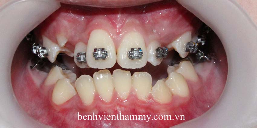 nieng rang chen chuc khong nho rang 1c