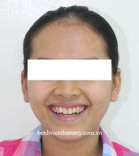 nieng-rang-mom-khong-nho-rang-1