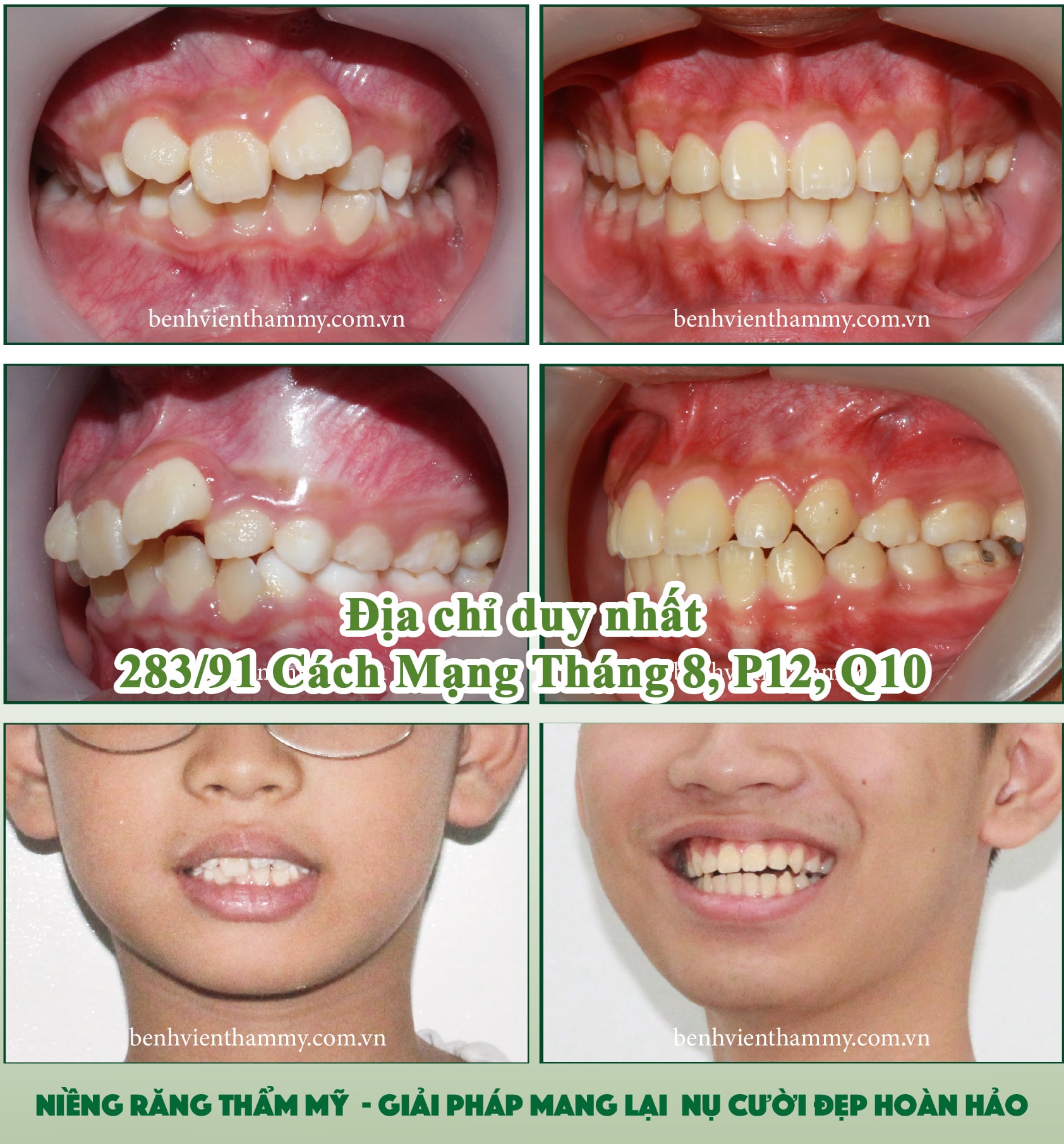 truoc va sau nieng rang chen chuc tre em 2