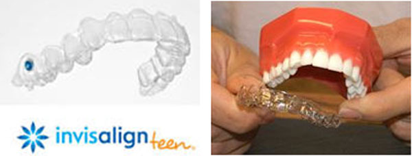 chinh-nha-invisalign-01
