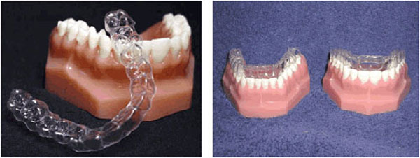 chinh-nha-invisalign-09