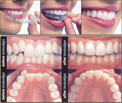chinh-nha-invisalign-10