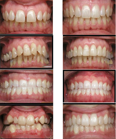 chinh-nha-invisalign-11