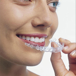 chinh-nha-invisalign-14