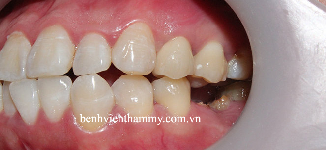 rang-su-dep-tu-nhien-1 copy