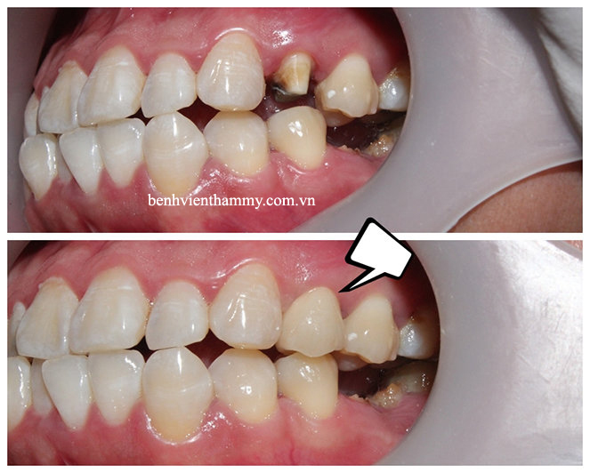 rang-su-dep-tu-nhien-2 copy