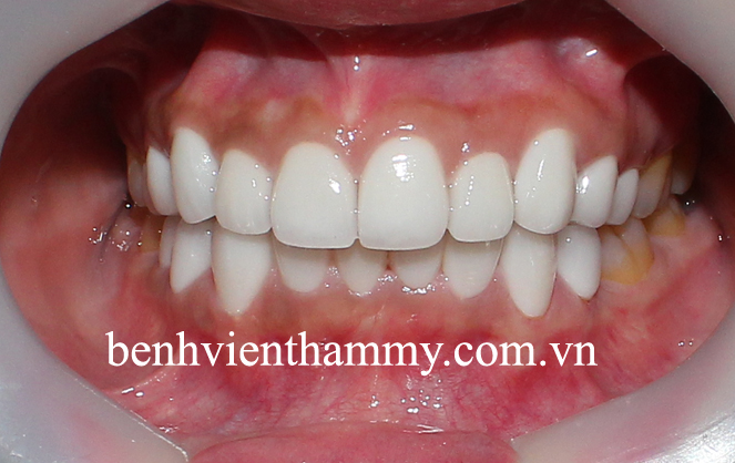 rang-su-dep-tu-nhien-4